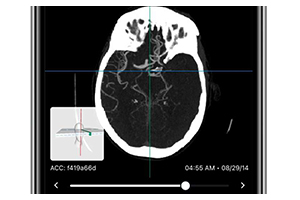 Study shows AI software improves endovascular thrombectomy treatment times for stroke patients