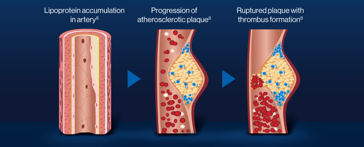 Diagram showing dyslipidaemia and the accumulation of lipoproteins within the arterial wall, which leads to the formation of atherosclerotic plaques.